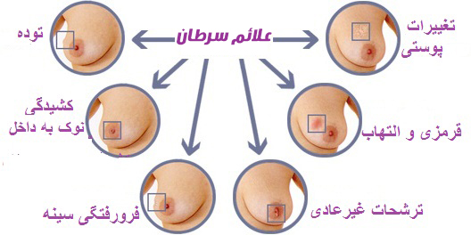 علائم سرطان پستان